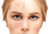 How To Remove Acne Fast?