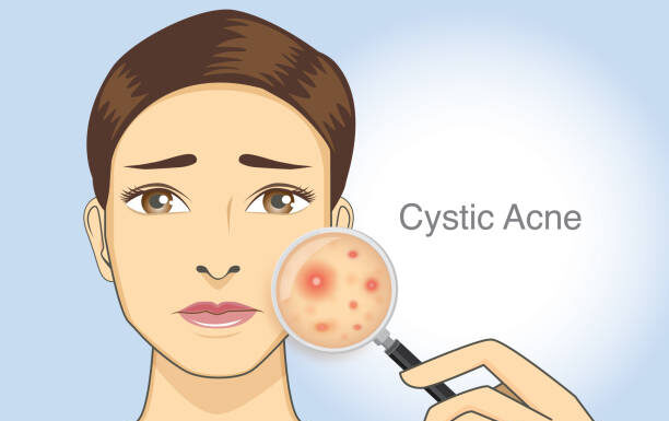 The Best Treatment For Cystic Acne