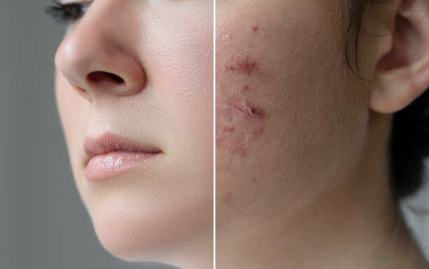 Skin Care Routine For Adult Acne