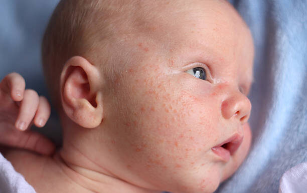 How To Treat Baby Acne?