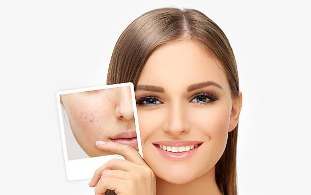How Can I Remove Acne Fast And Naturally?