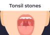 What Causes Tonsil Stones? Symptoms, Diagnosis, Prevention, Complications, and Treatment what causes tonsil stones?