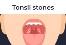 What Causes Tonsil Stones? Symptoms, Diagnosis, Prevention, Complications, and Treatment what causes tonsil stones?