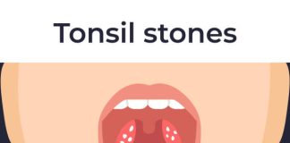 what causes tonsil stones?