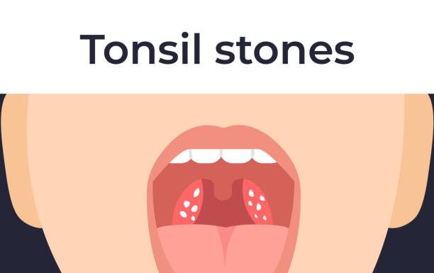 What Causes Tonsil Stones? Symptoms, Diagnosis, Prevention, Complications, and Treatment what causes tonsil stones?
