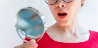 stress and acne in adults