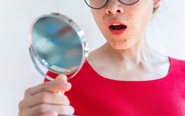 Stress And Acne In Adults stress and acne in adults