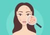 Hormonal Acne Treatments for Adults Hormonal acne | causes and treatments
