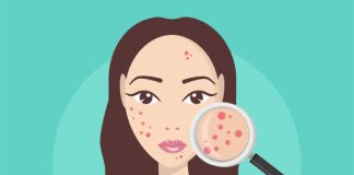 Hormonal acne | causes and treatments