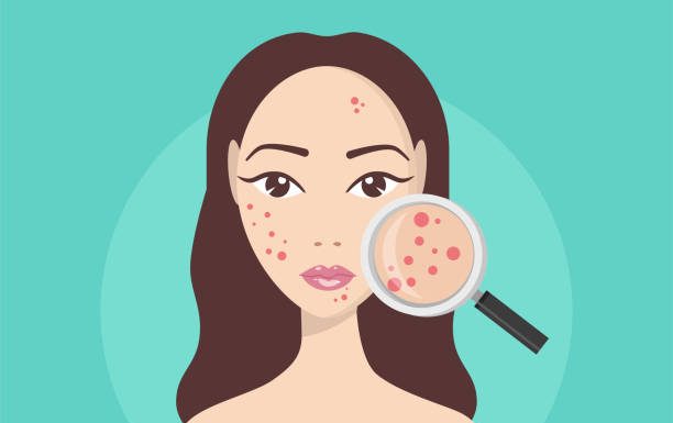 Hormonal Acne Treatments for Adults Hormonal acne | causes and treatments