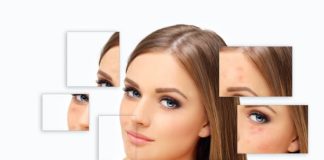 how to remove acne scars fast?