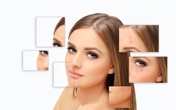 How To Remove Acne Scars Overnight? how to remove acne scars fast?