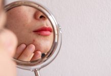 Adult Acne Around the Mouth: Causes and How to Deal with It? adult acne around the mouth