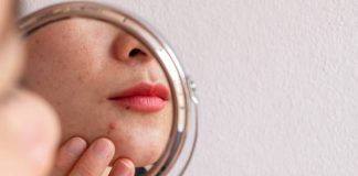 adult acne around the mouth
