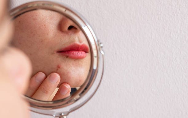 Adult Acne Around the Mouth: Causes and How to Deal with It? adult acne around the mouth