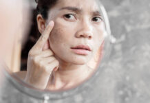 How to Treat Stress Rash on The Face? stress rash on face