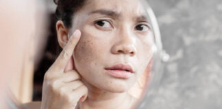 stress rash on face