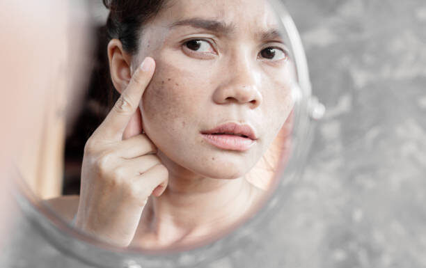 How to Treat Stress Rash on The Face? stress rash on face