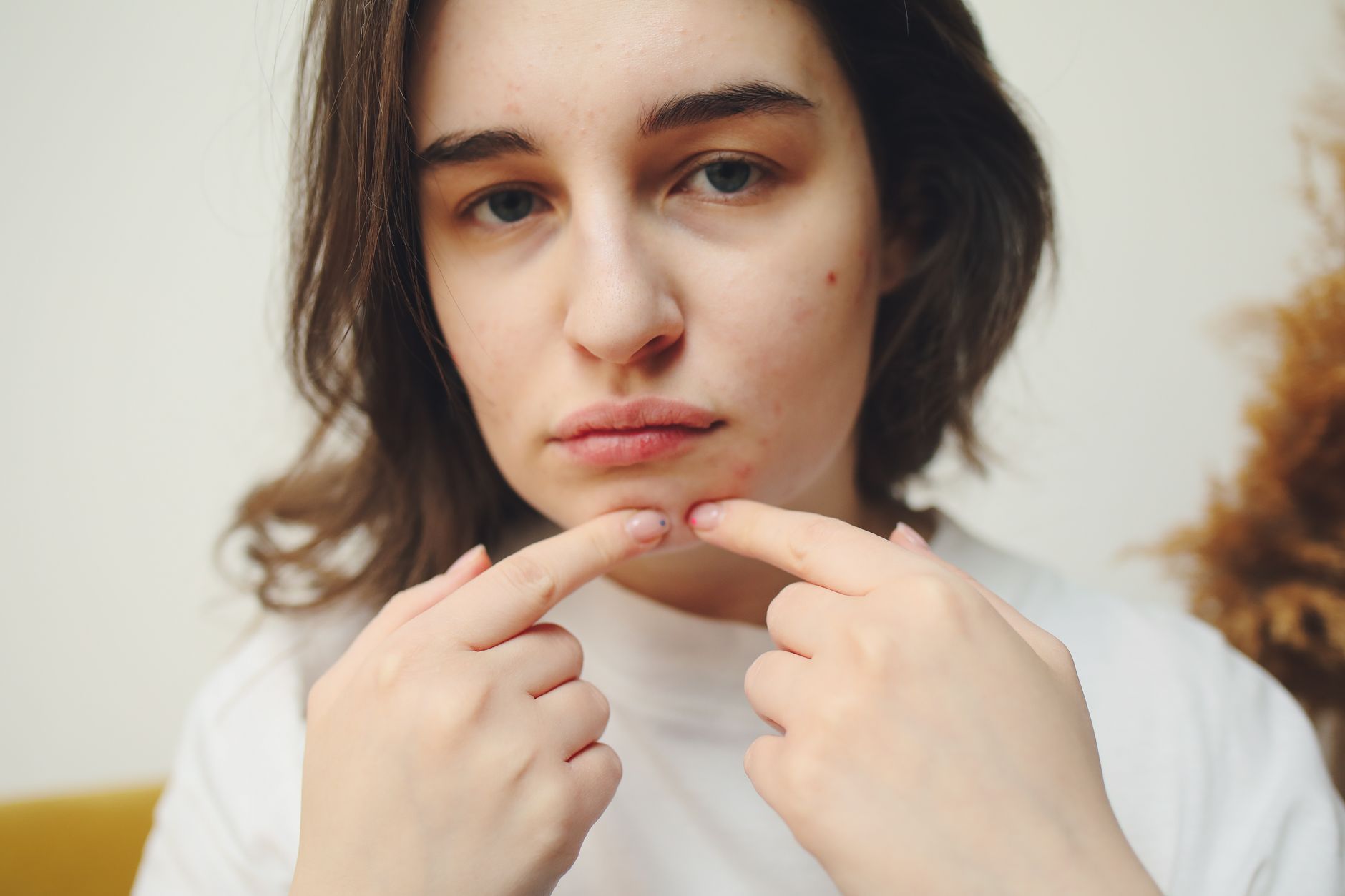 A dermatologist consulting with a patient about various types of acne and skin care.